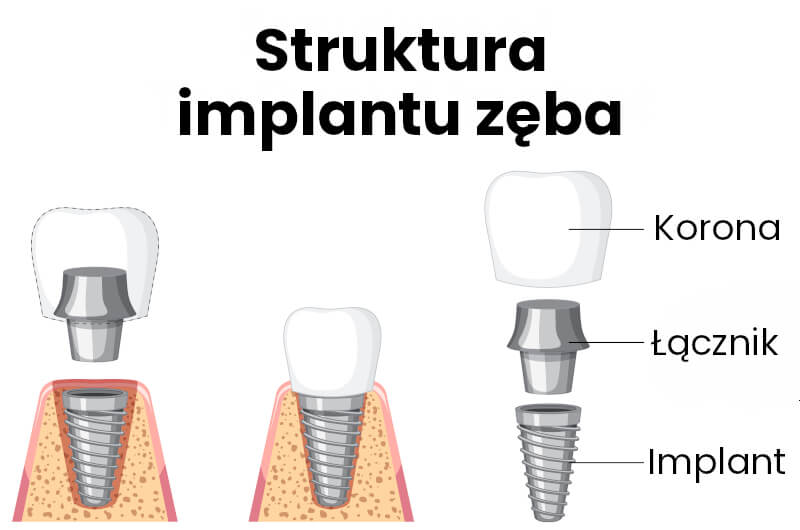 struktura implantu zeba.jpg
