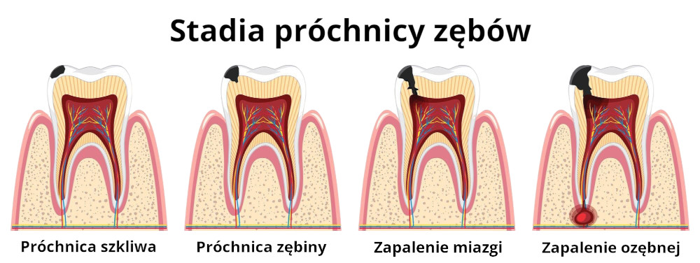stadia próchnicy zębów.jpg